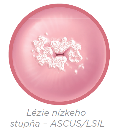 Zlý výsledok cytológie? Čo presne znamenajú skratky ASCUS a LSIL a aké sú vaše možnosti
