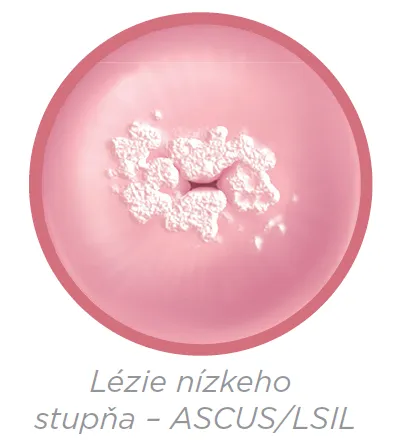 Ilustračný obrázok lézie krčka maternice